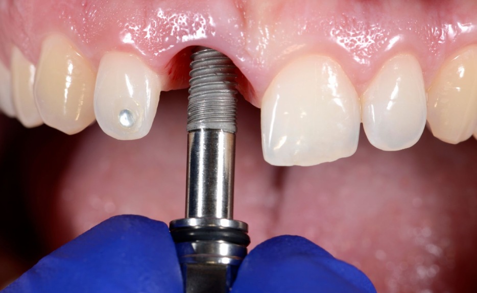 An example of someone smiling with dental implants